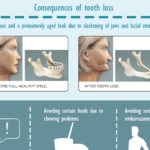 losing teeth feature