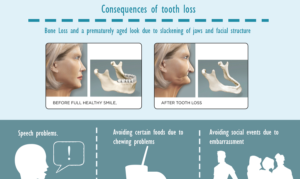 losing teeth feature